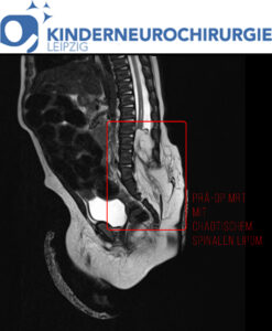 Kinderneurochirurgie Salzburg Intraspinales chaotisches Lipom bei MMC - vor Entfernung