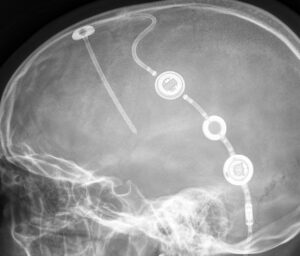 M.Scio Inline Version im Röntgenbild